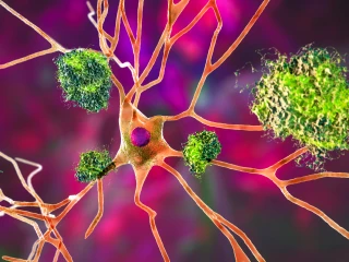 amyloid