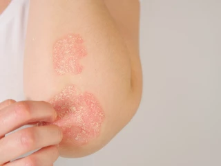 Psoriáza_ruce
