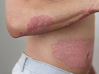 psoriaza1