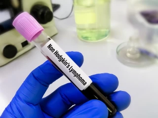 Non-Hodgkinovy lymfomy
