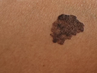 AI v klinické dermatologii? Nový model pomůže s diagnostikou