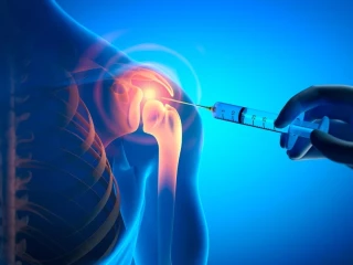 Romosozumab vs. teriparatid − přímé porovnání osteoanabolické léčby postmenopauzální osteoporózy