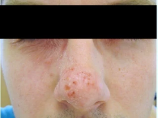 Exacerbace projevů atopické dermatitidy v obličeji