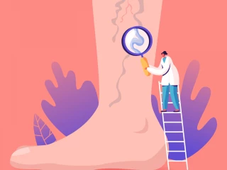 noha ilustrace trombozy tromboza