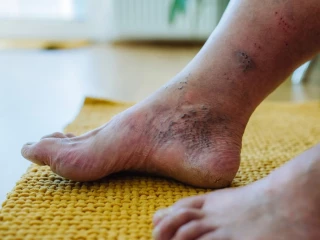 TEWL jako nový prediktor recidivy diabetických ulcerací na noze