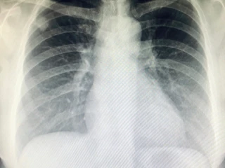 NSCLC