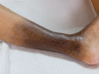 chronic venous insufficiency