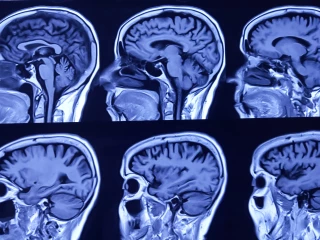 MRI scan 25