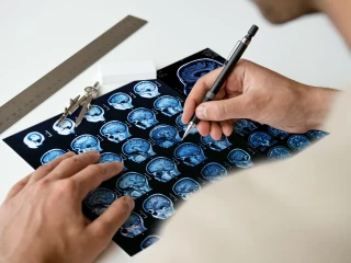 mozek mri scan roztroušená skleróza