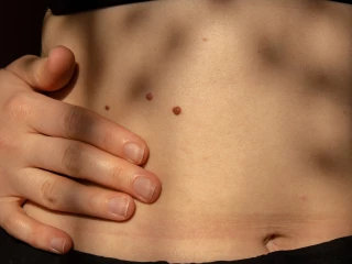 Diagnostika kožních malignit