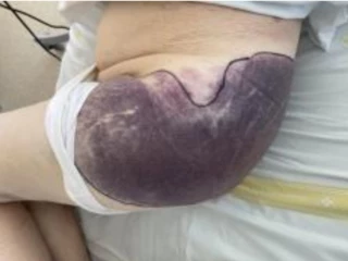 Získaná hemofilie A nově diagnostikovaná u pacientky v pokročilém věku − kazuistika