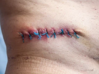 heal wounds