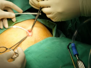 Peritoneální dialýza_operace_zavedení katetru