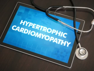 hypertrofická kardiomyopatie