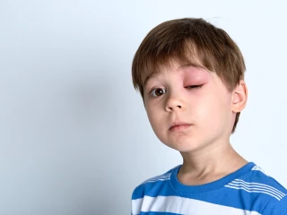 nateklé oko kluk angioedém