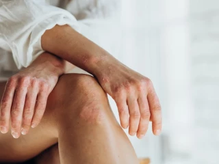 Kombinace psoriázy a axiální PsA u mladé ženy: rychlý, výrazný a trvalý efekt díky bimekizumabu – kazuistika