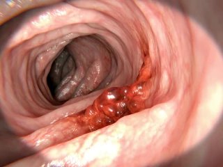 karcinom kolorekta, CRC, Colorectal cancer