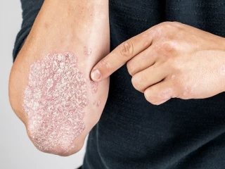 psoriaza