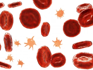 immune thrombocytopenia