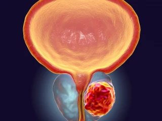 kresba_karcinom_prostata