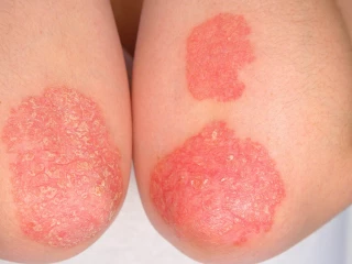 pacientů s psoriázou