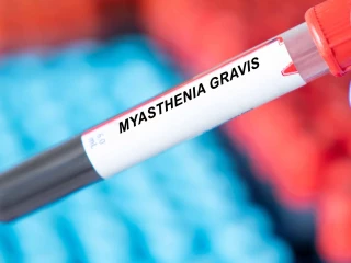 myasthenia gravis