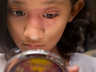 dermatitida u dětí dívka vyrážka vzhled kůže