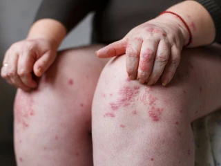 Psoriáza na těle pacienta