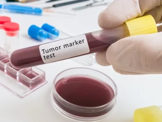 marker_markery_rakovina_krev_test_laborator_zkumavka