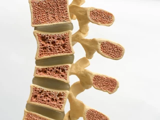 Osteoporoza kost