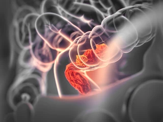 Kolorektální karcinom - anatomie
