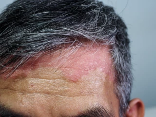 plaková psoriaza čelo