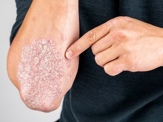 psriasis