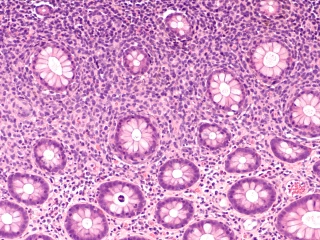 DLBCL