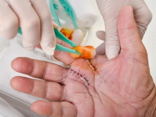 wound dressing care,