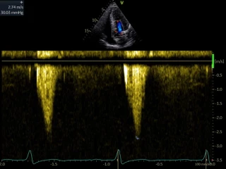 BMS HCM obr. 2