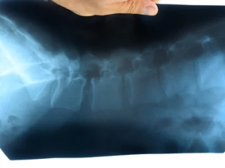 spondylartritida