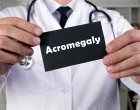 Akromegalie