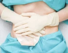 stoma nurse