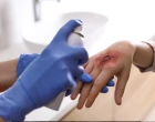 debridement09