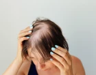 Alopecia