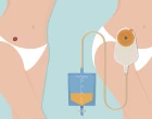 UROSTOMY