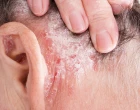 plakova psoriaza
