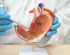 31dyspepsia