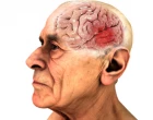 alzheimer hlava deda