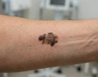Nový test uchránil některé pacienty s melanomem biopsie sentinelové uzliny