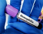 hemophilia image