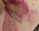 hidradenitis suppurativa