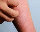 atopická dermatitida na ruce