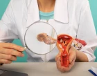ovaria cancer